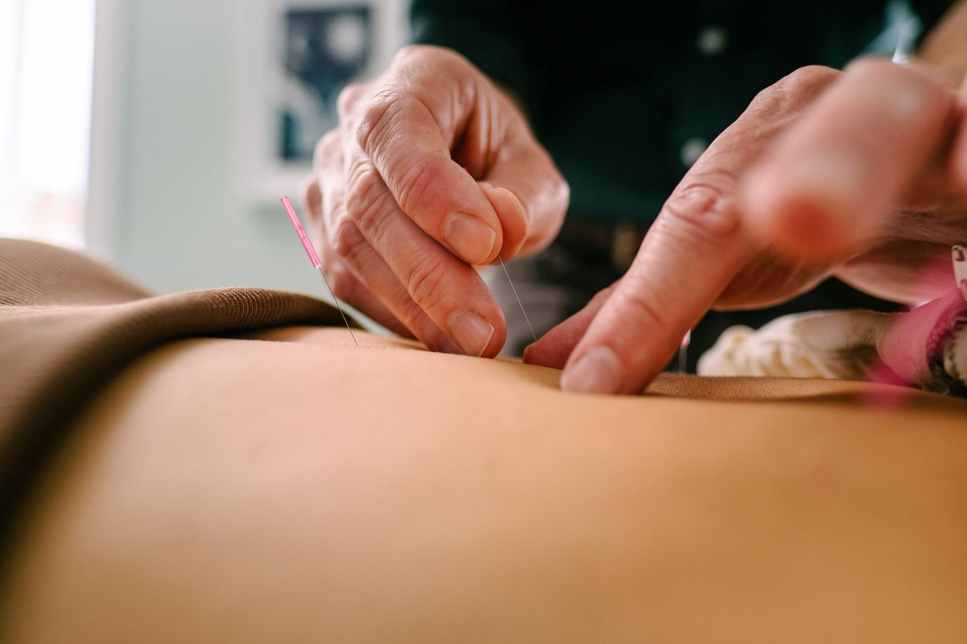 Jude placing fine acupuncture needles