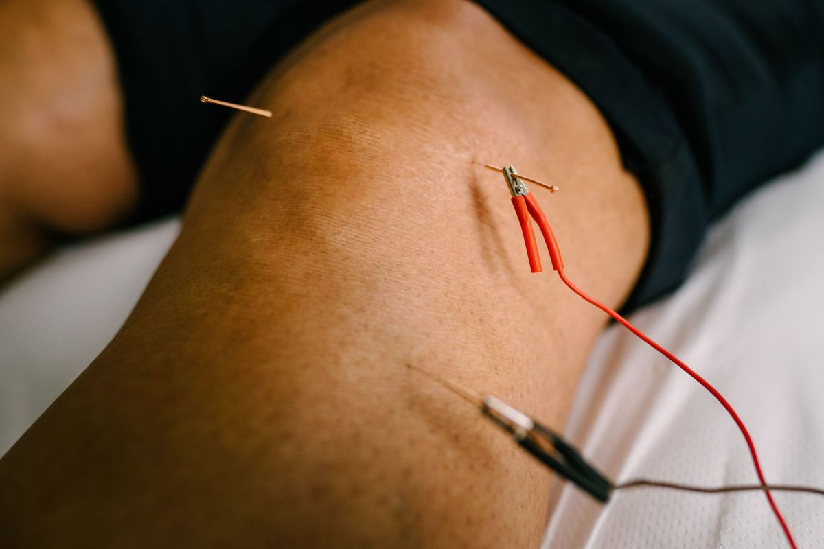 Electroacupuncture clips attached to fine needles